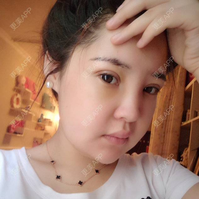 更美 - xirennnnn的定点双眼皮经验 | 双下巴溶脂 | 光纤溶脂瘦脸. | 光纤溶脂下巴 | 定点双眼皮 | 激光溶脂瘦脸 | 开外眼角 | 南昌