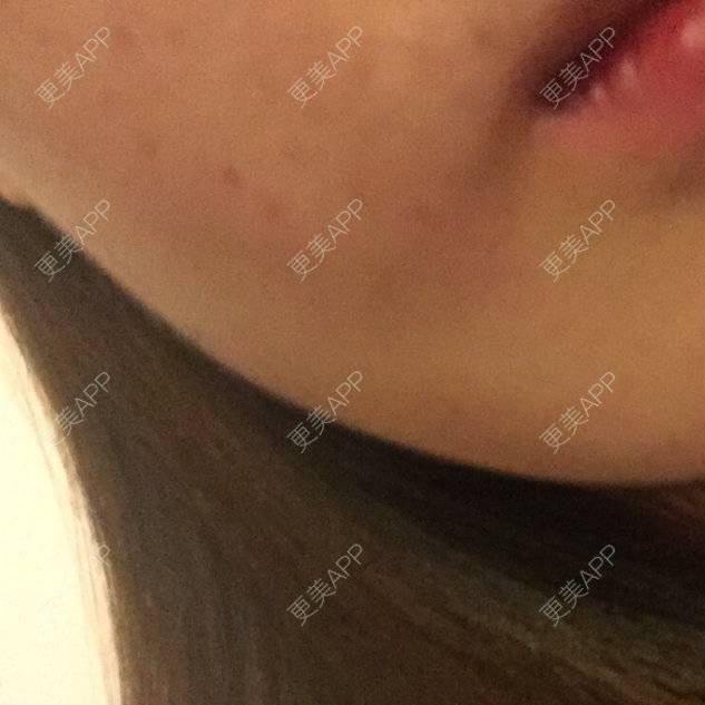 更美 - shj888的吸脂瘦脸经验 | 吸脂瘦脸 | 美购日记 | 广州