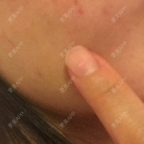 更美 - shj888的吸脂瘦脸经验 | 吸脂瘦脸 | 美购日记 | 广州