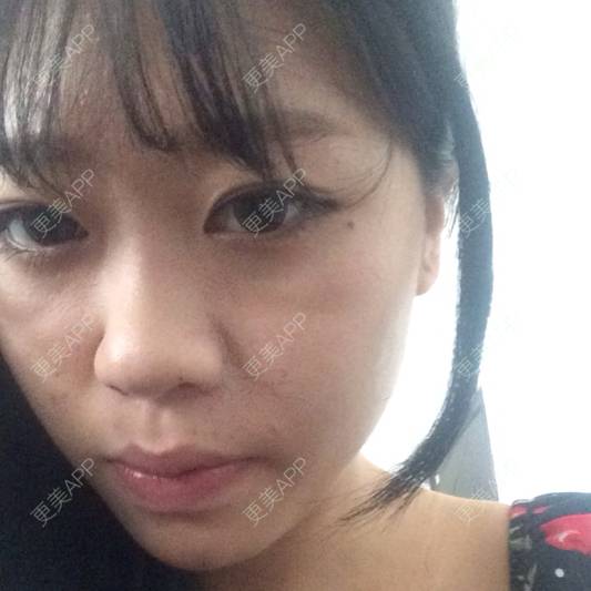 更美 - 最爱的前女友的经验 | 玻尿酸法令纹