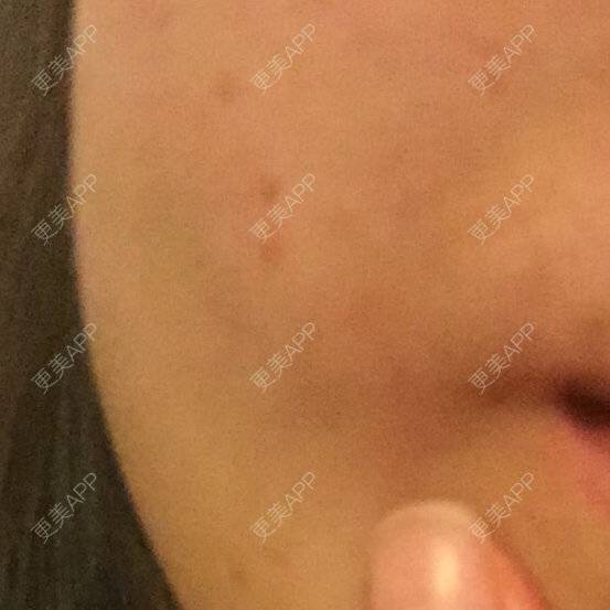 更美 - shj888的吸脂瘦脸经验 | 吸脂瘦脸 | 美购日记 | 广州