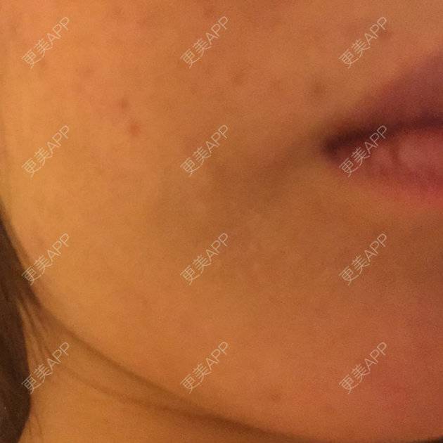 更美 - shj888的吸脂瘦脸经验 | 吸脂瘦脸 | 美购日记 | 广州