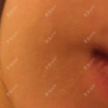 更美 - shj888的吸脂瘦脸经验 | 吸脂瘦脸 | 美购日记 | 广州