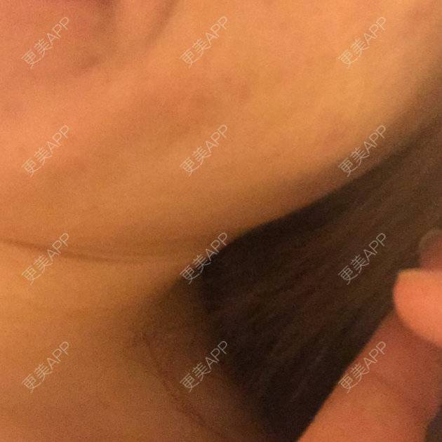 更美 - shj888的吸脂瘦脸经验 | 吸脂瘦脸 | 美购日记 | 广州