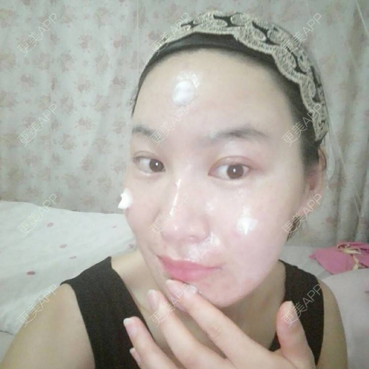 更美 - 更美用户27416885的激光淡化红血丝经验 | 果酸焕肤 | 红蓝光清痘 | 激光淡化红血丝 | 上海