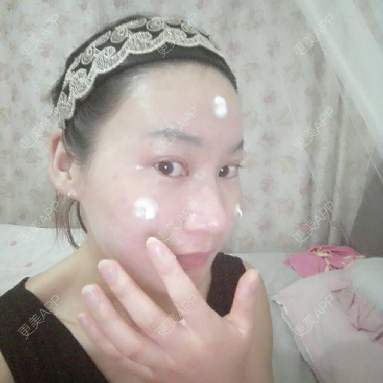 更美 - 更美用户27416885的激光淡化红血丝经验 | 果酸焕肤 | 红蓝光清痘 | 激光淡化红血丝 | 上海