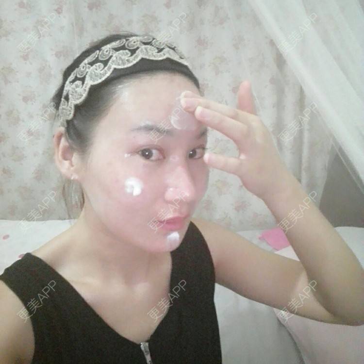 更美 - 更美用户27416885的激光淡化红血丝经验 | 果酸焕肤 | 红蓝光清痘 | 激光淡化红血丝 | 上海