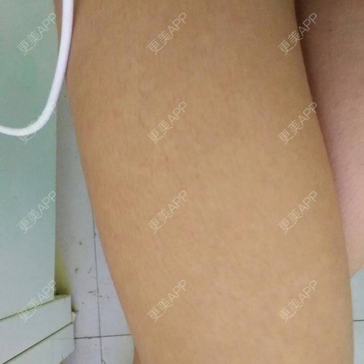 更美 - 更美用户49282978的经验 | 脱唇毛