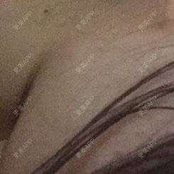 更美 - shj888的吸脂瘦脸经验 | 美购日记 | 吸脂瘦脸 | 广州