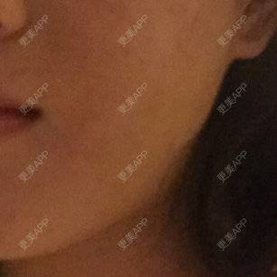 更美 - shj888的吸脂瘦脸经验 | 美购日记 | 吸脂瘦脸 | 广州