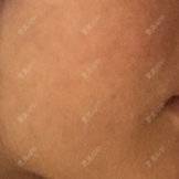 更美 - shj888的吸脂瘦脸经验 | 美购日记 | 吸脂瘦脸 | 广州