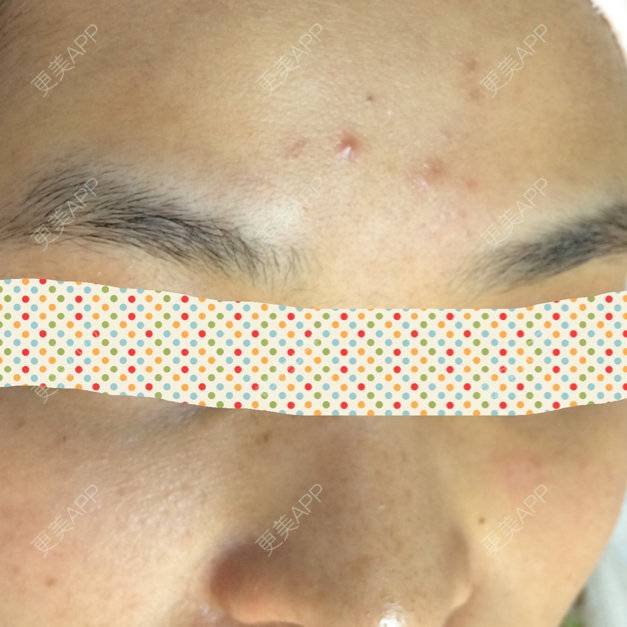 更美 - nigxs的半永久纹眉经验 | 毛发整形 | 飘眉 | 绣眉 | 半永久纹眉 | 深圳
