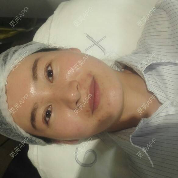 更美 - 更美用户27416885的激光淡化红血丝经验 | 果酸焕肤 | 红蓝光清痘 | 激光淡化红血丝 | 上海