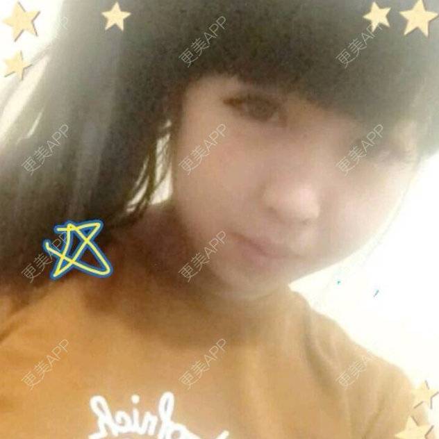 更美 - 13*******52的经验 | 鼻部玻尿酸 | 下巴微整 | 脸部溶脂针 | 北京