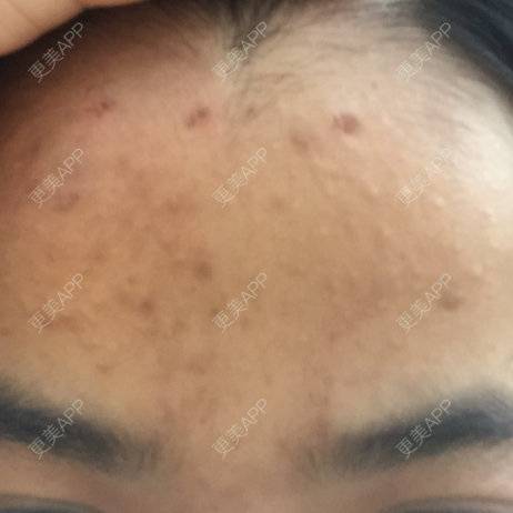 更美 - 更美用户80572856的经验 | 红蓝光清痘