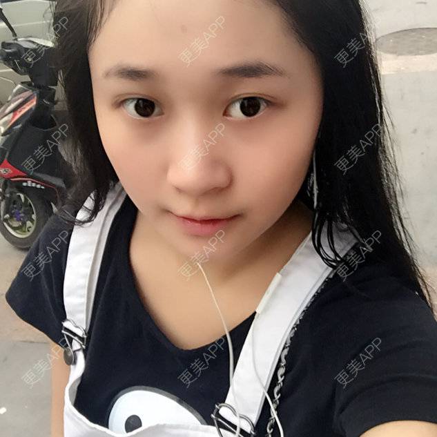 更美 - 呆子。的经验 | 韩式三点双眼皮 | 开后眼角 | 合肥