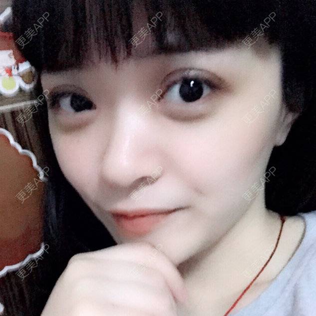 更美 - 更美用户54143766的全切双眼皮经验 | 开内眼角 | 上眼睑去脂 | 全切双眼皮 | 眼皮下垂矫正 | 苏州
