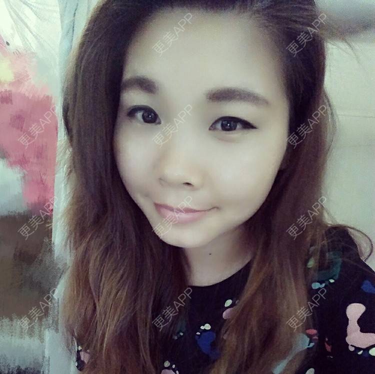 更美 - Cond-y的经验 | 外切去眼袋 | 长沙