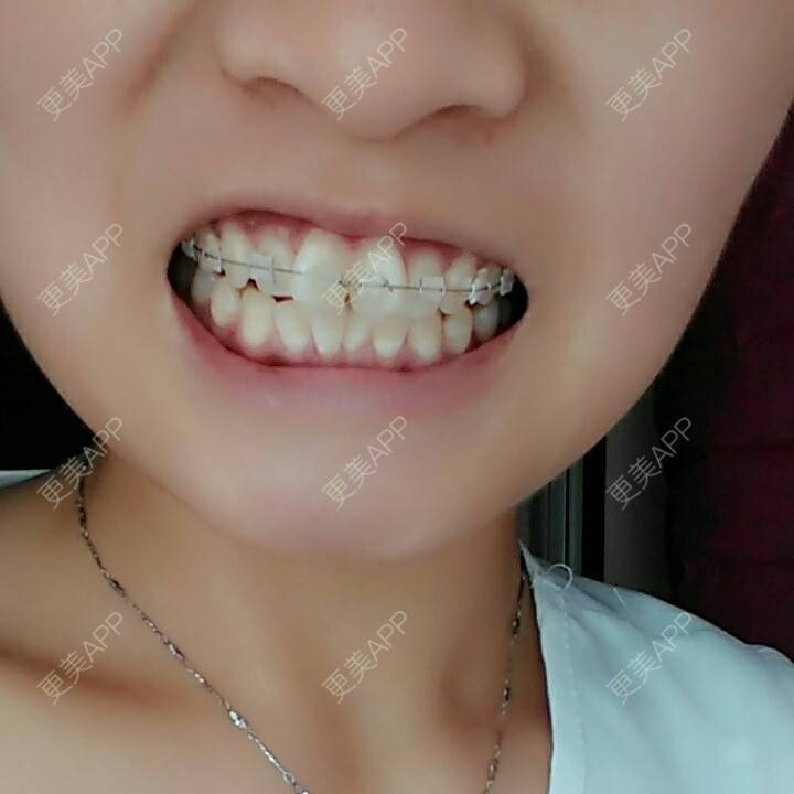 更美 - 更美一直美美的的牙齿矫正经验 | 龅牙 | 牙列拥挤 | 拔牙 | 牙齿矫正 | 蛀牙 | 孝感