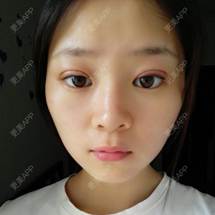 更美 - 请叫我洋气姐的定点双眼皮经验 | 海口