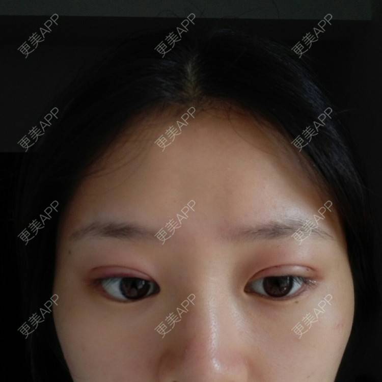 更美 - 请叫我洋气姐的定点双眼皮经验 | 海口