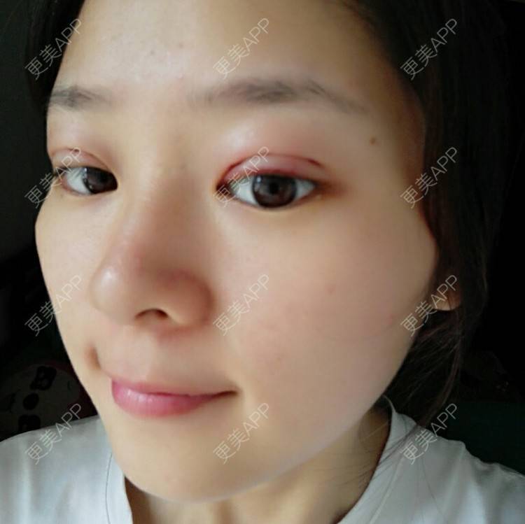 更美 - 请叫我洋气姐的定点双眼皮经验 | 海口