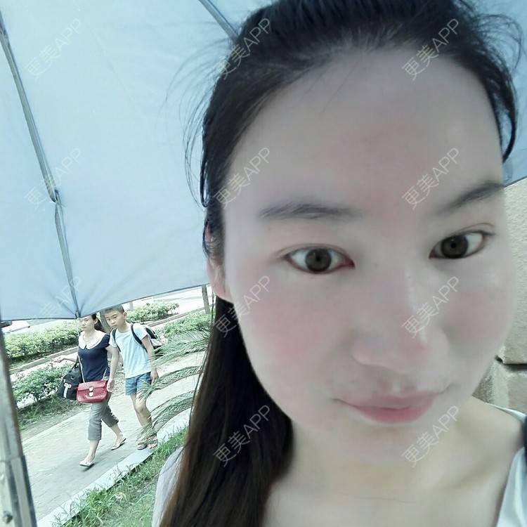 更美 - 更美用户27416885的激光淡化红血丝经验 | 果酸焕肤 | 红蓝光清痘 | 激光淡化红血丝 | 上海