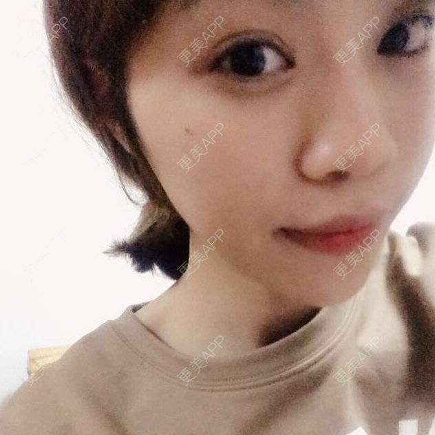 更美 - 更美用户87523430的定点双眼皮经验 | 自体脂肪丰面颊 | 自体脂肪丰太阳穴 | 激光脱发际线 | 自体脂肪丰额头 | 鬓角植发 | 胶原蛋白填充苹果肌 | 定点双眼皮 | 玻尿酸下巴 | 衢州