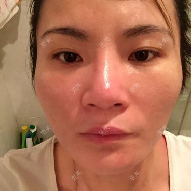 做歪鼻整形安全不安全_鼻整形歪了怎么办_做歪鼻整形
