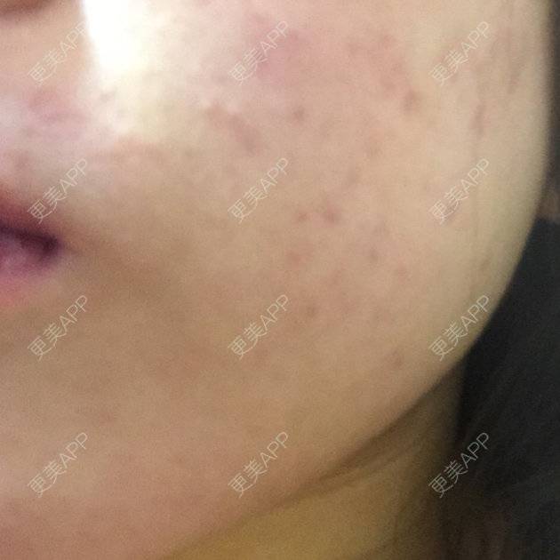 更美 - shj888的吸脂瘦脸经验 | 美购日记 | 吸脂瘦脸 | 广州