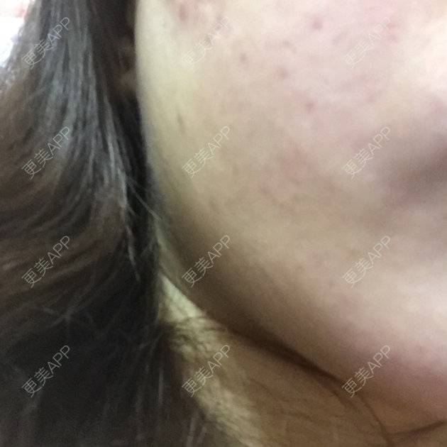 更美 - shj888的吸脂瘦脸经验 | 美购日记 | 吸脂瘦脸 | 广州