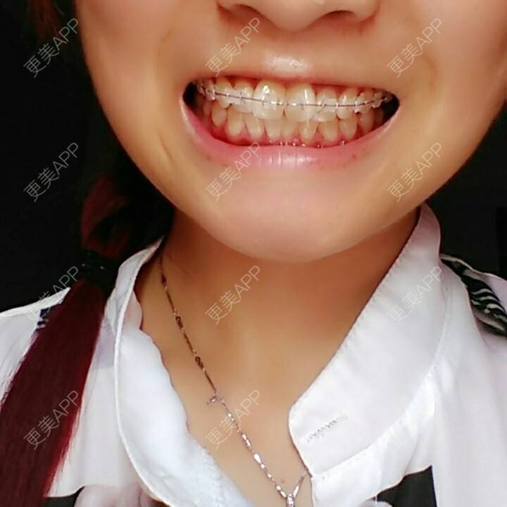 更美 - 更美一直美美的的牙齿矫正经验 | 龅牙 | 牙列拥挤 | 拔牙 | 牙齿矫正 | 蛀牙 | 孝感
