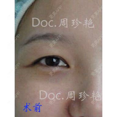 更美 - 周珍艳 医生的经验 | 眼部整形 | 术后求抱抱 | 精选问答 | 上海