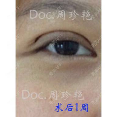 更美 - 周珍艳 医生的经验 | 眼部整形 | 术后求抱抱 | 精选问答 | 上海