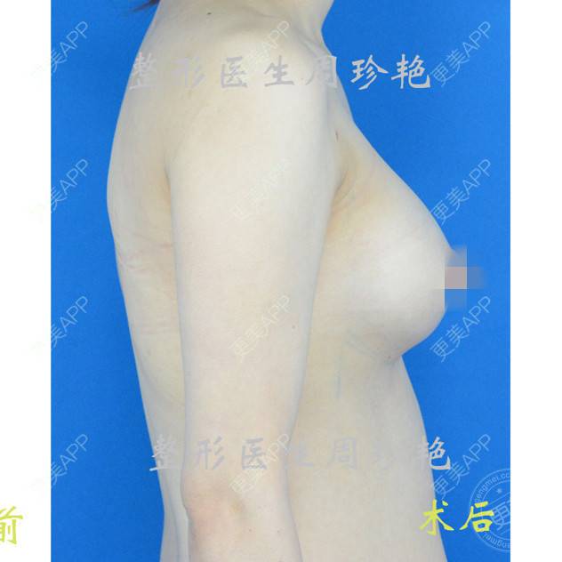 更美 - 周珍艳 医生的经验 | 胸部塑身 | 愿望清单 | 精选问答 | 上海