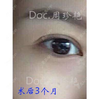 更美 - 周珍艳 医生的经验 | 眼部整形 | 术后求抱抱 | 精选问答 | 上海