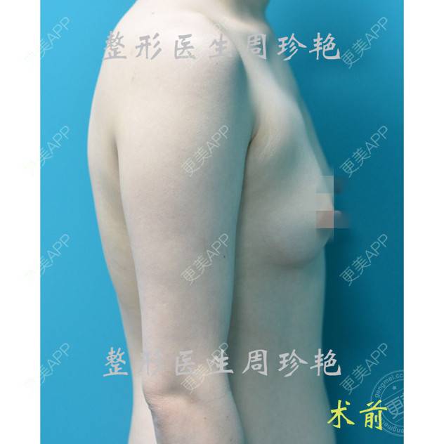 更美 - 周珍艳 医生的经验 | 胸部塑身 | 愿望清单 | 精选问答 | 上海