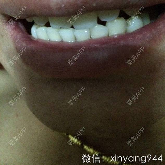 更美 - 蓝色夏威夷的经验 | 冷光美白 | 美白牙齿 | 唯爱牙齿冷光美白仪 | 北京