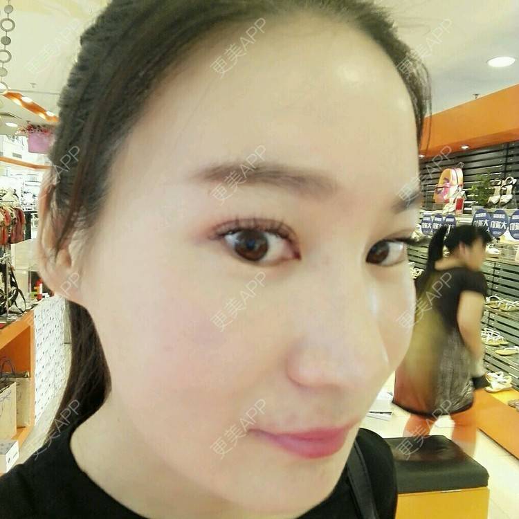更美 - 更美用户27416885的激光淡化红血丝经验 | 果酸焕肤 | 红蓝光清痘 | 激光淡化红血丝 | 上海