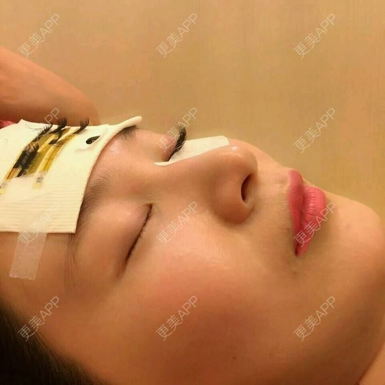 更美 - 更美用户27416885的激光淡化红血丝经验 | 果酸焕肤 | 红蓝光清痘 | 激光淡化红血丝 | 上海