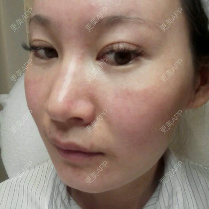 更美 - 更美用户27416885的激光淡化红血丝经验 | 皮肤美容 | 果酸焕肤 | 红蓝光清痘 | 激光淡化红血丝 | 上海