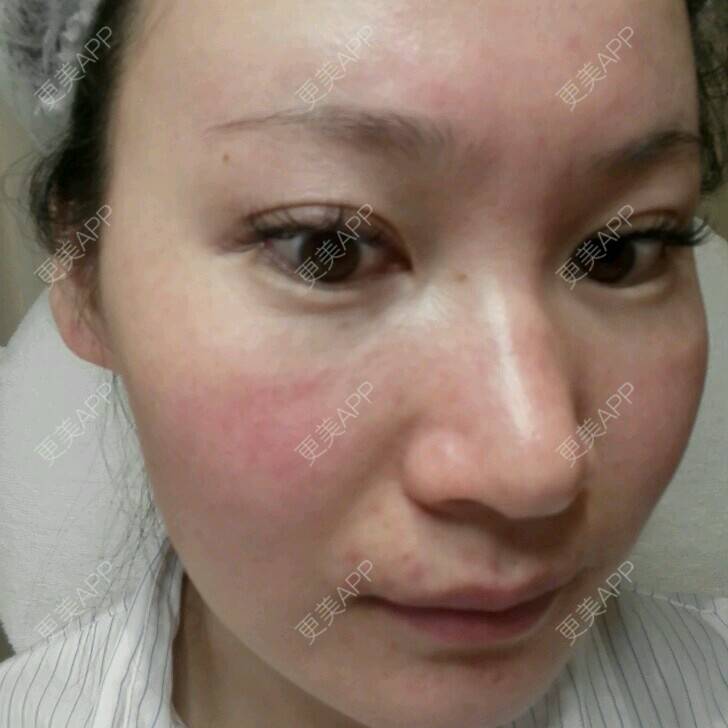 更美 - 更美用户27416885的激光淡化红血丝经验 | 皮肤美容 | 果酸焕肤 | 红蓝光清痘 | 激光淡化红血丝 | 上海