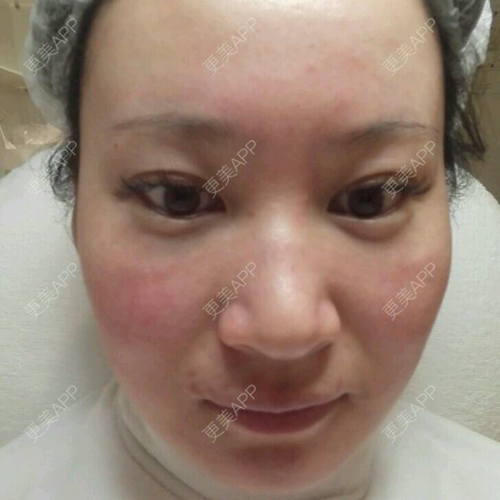 更美 - 更美用户27416885的激光淡化红血丝经验 | 皮肤美容 | 果酸焕肤 | 红蓝光清痘 | 激光淡化红血丝 | 上海