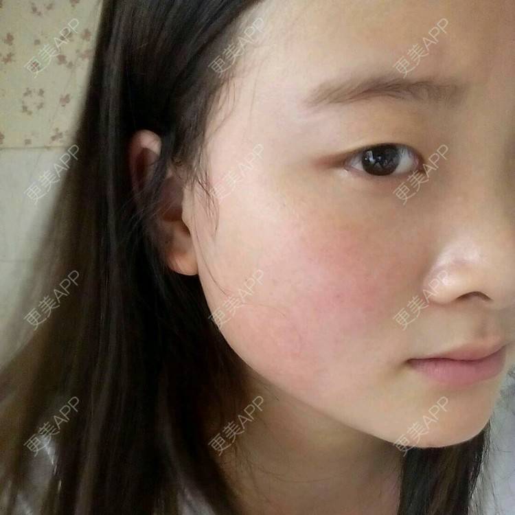 更美 - Melancholy的经验 | 激光淡化红血丝 | 遵义