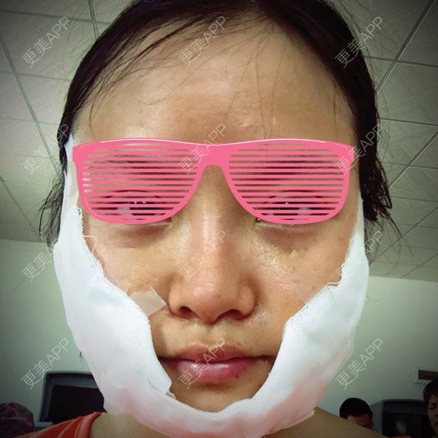 更美 - 你是我的小宝贝呀的自体脂肪填充泪沟经验 | 自体脂肪丰苹果肌 | 广州 | 自体脂肪填充泪沟 | 美购日记