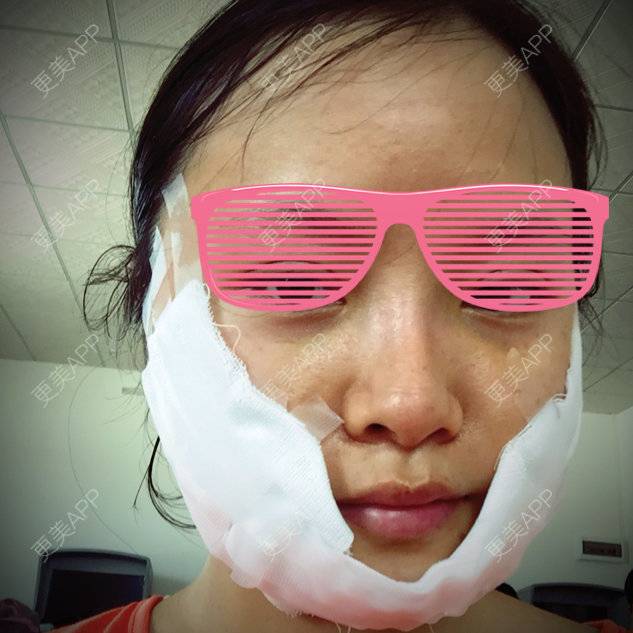 更美 - 你是我的小宝贝呀的自体脂肪填充泪沟经验 | 自体脂肪丰苹果肌 | 广州 | 自体脂肪填充泪沟 | 美购日记