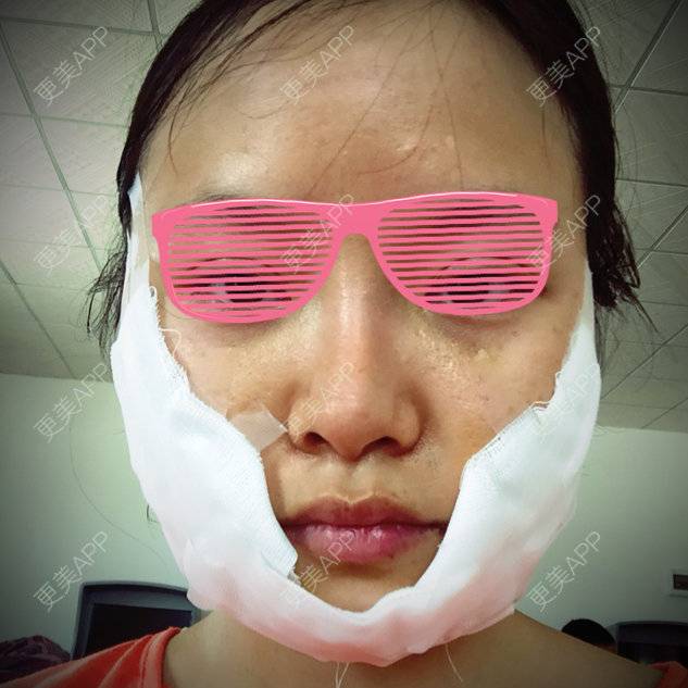 更美 - 你是我的小宝贝呀的自体脂肪填充泪沟经验 | 自体脂肪丰苹果肌 | 广州 | 自体脂肪填充泪沟 | 美购日记