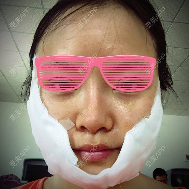 更美 - 你是我的小宝贝呀的自体脂肪填充泪沟经验 | 自体脂肪丰苹果肌 | 广州 | 自体脂肪填充泪沟 | 美购日记