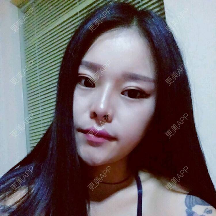 更美 - boss  安迪的经验 | 定点双眼皮 | 除皱瘦脸 | 溶脂针