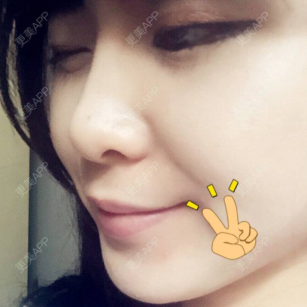 更美 - 我有一头小毛驴的自体脂肪隆鼻经验 | 西安 | 自体脂肪丰太阳穴 | 自体脂肪隆鼻 | 美购日记 | 自体脂肪垫下巴